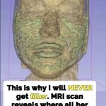 Plastic surgeon reveals damage fillers do in long term