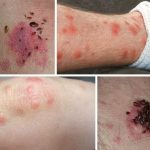 BE CAREFUL if you get these bruises on your body, it means you have Ca…