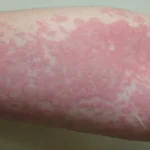 Health What’s Really Causing Your Hives? Unexpected Triggers