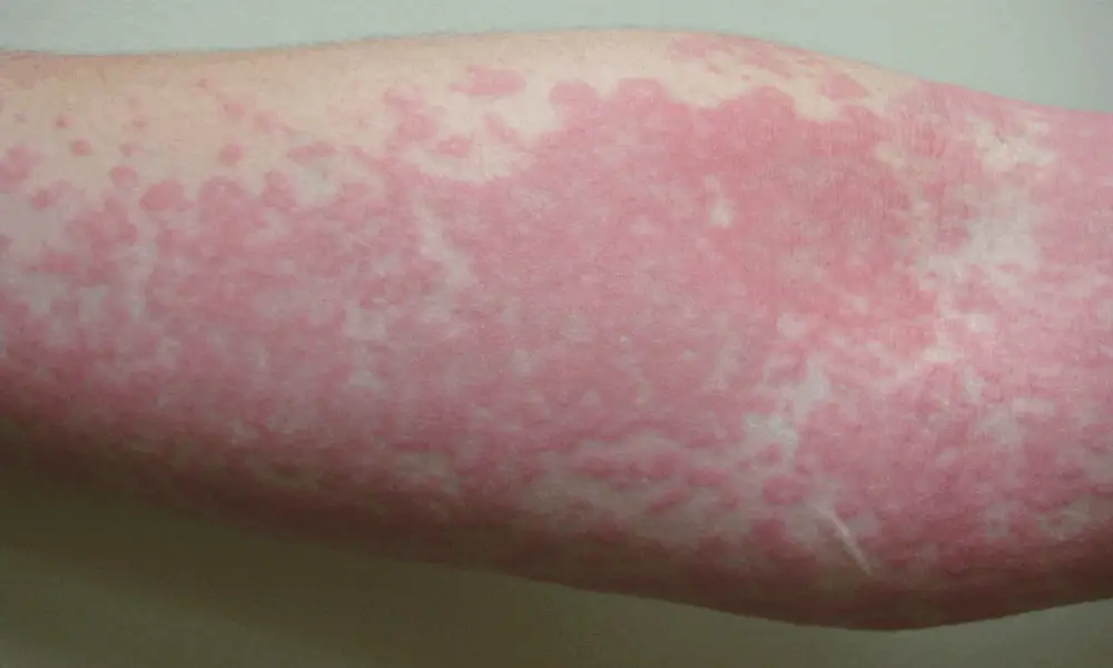 Health What’s Really Causing Your Hives? Unexpected Triggers