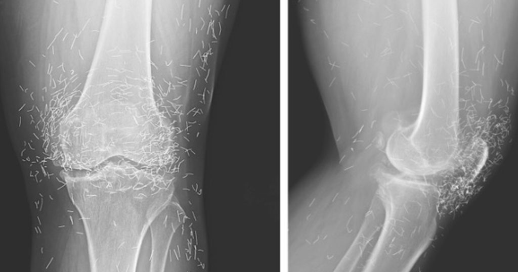 Doctors find “gold mine” in woman’s knees