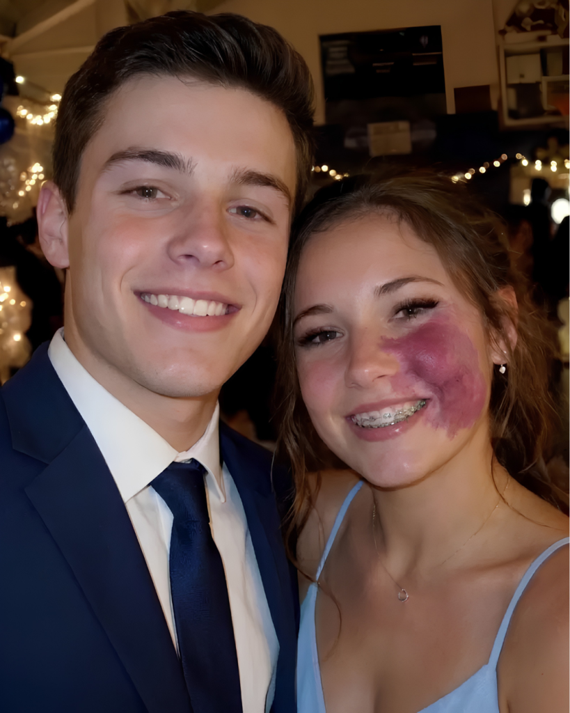 Only one boy asked me to prom because no one else wanted to go with me because of the birthmark on my face — everyone laughed until police officers walked into the gym.